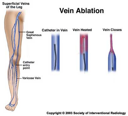 Varicose Veins Treatment: A Q&A with UCSF Interventional Radiologists